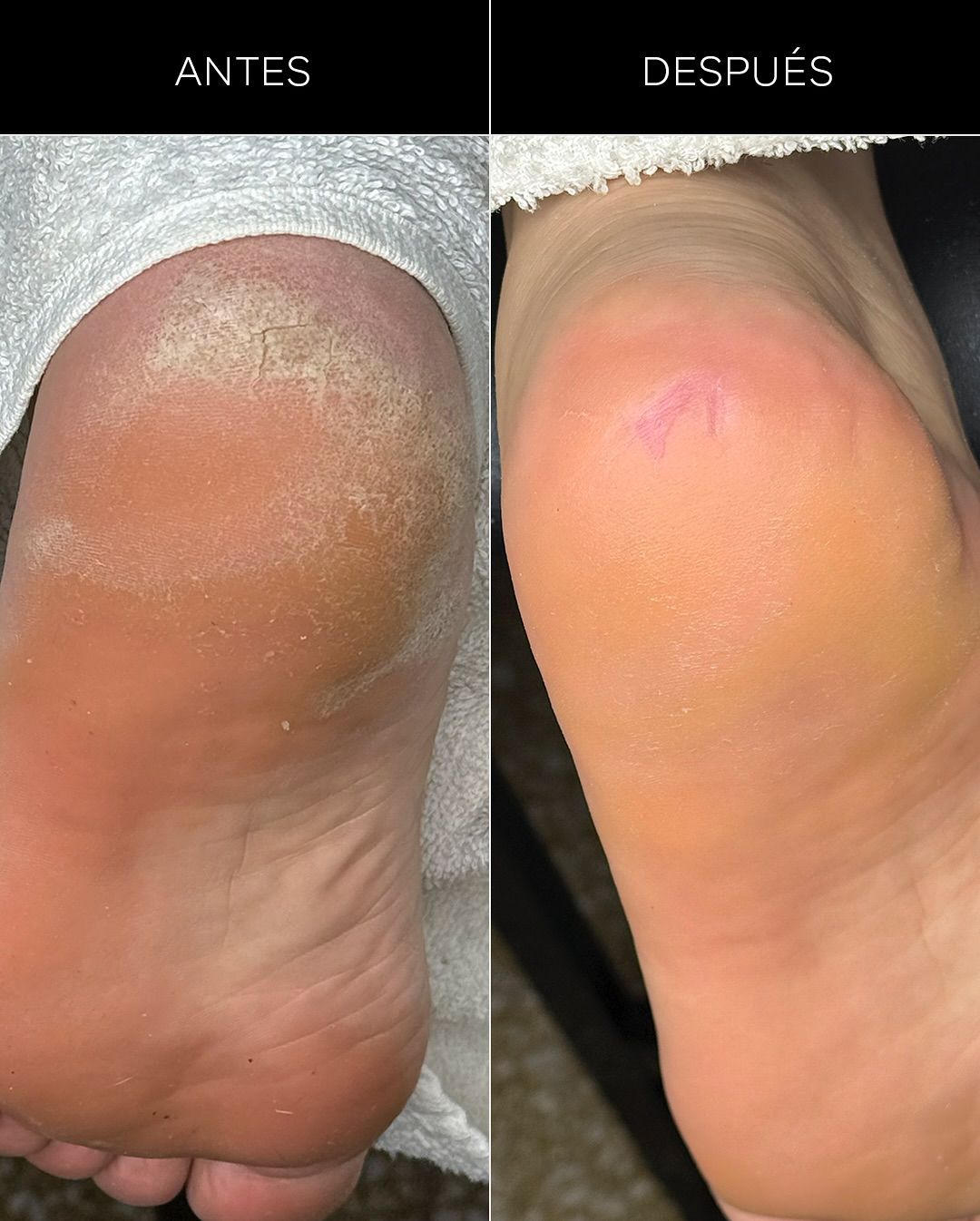 callus remover 250ml pink mask